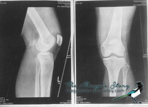 Left knee X-ray ... How to get an ACL & Meniscus injury right before your school exams ? #ACL , #ACLinjury , #ACLandmeniscus , #magpiestory Knee Sprain, Meniscus Injury, Netball, Knee Injury, X Ray, On Earth, Do It, Quick Saves