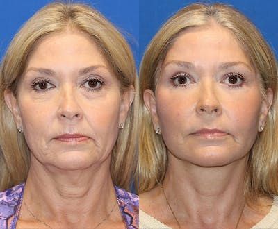 Patient 71700612 | Vertical Restore® / Facial Rejuvenation Before & After Photos | Carmel Valley Plastic Surgery Restylane Lyft, Laser Peel, Skin Care Guide, Fat Transfer, Lip Augmentation, Facial Plastic Surgery, Facial Rejuvenation, Brow Lift, Reconstructive Surgery