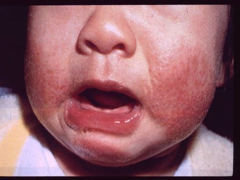 Baby Eczema: Natural Remedies for This Common Skin Condition Face Rash Remedies, Baby Rash On Face, Rash On Face, Rashes Remedies, Facial Warts, Natural Baby, Natural Treatments, Skin Conditions, Infants