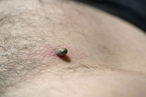 Bites from infected ticks can cause a rash, fever, chills, headache, fatigue, and can lead to serious health complications if left untreated. Tick Bites Pictures, Tick Bite Symptoms, Common Skin Rashes, Types Of Ticks, Body Rash, Fever Symptoms, Guillain Barre, Tick Bite, Spider Bites