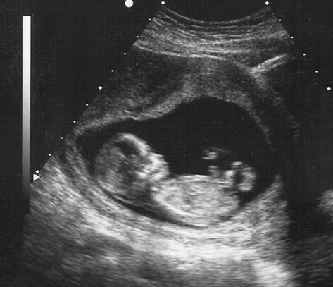 13 Week Ultrasound, Fake Ultrasound, Baby Ultrasound Pictures, 13 Weeks Pregnant, Fake Pregnancy, Sonogram Pictures, Pregnancy Ultrasound, Teenage Pregnancy, Baby Ultrasound