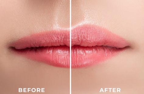 Lip Flip vs. Filler – Which is Right for you? | AquaVitae Lip Fillers Juvederm, Lip Flip, Botox Before And After, Botox Lips, Large Lips, Too Much Estrogen, Lip Augmentation, Lip Enhancement, Lip Shapes