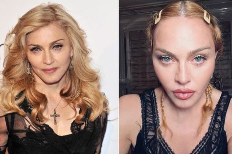 Madonna Now, Bacterial Infection, Take A Break, Plastic Surgery, Celebrity Gossip, Then And Now, Madonna, Celebrity News, And Now