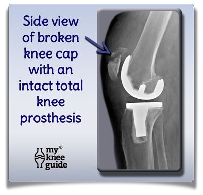 Pain after knee replacement can come from many sources.  This picture shows a fracture of the knee cap with an intact prosthesis. Broken Knee Cap, Broken Knee, After Knee Replacement Surgery, Before After Surgery, Knee Pictures, Knee Health, Knee Cap, Knee Replacement Surgery, Apple App