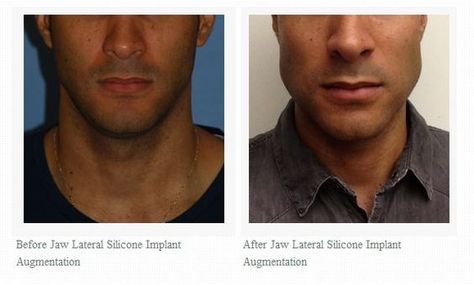 Jaw Lateral Silicone Implant Augmentation Before and After Images at 3 weeks Silicone Implants, Before After Photo, Plastic Surgery, College Outfits, Mother Of The Bride Dresses, Glow Up?, 3 Weeks, Mother Of The Bride, Mens Hairstyles