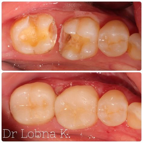 Dr. Lobna Khardani’s Instagram photo: “Change your defective and old composite fillings to #ceramic fillings ⭐️ Done in one session 😎 Welcome to the future…” Composite Fillings, Welcome To The Future, To The Future, You Changed, The Future, Composition, Ceramics, Instagram Photo, On Instagram