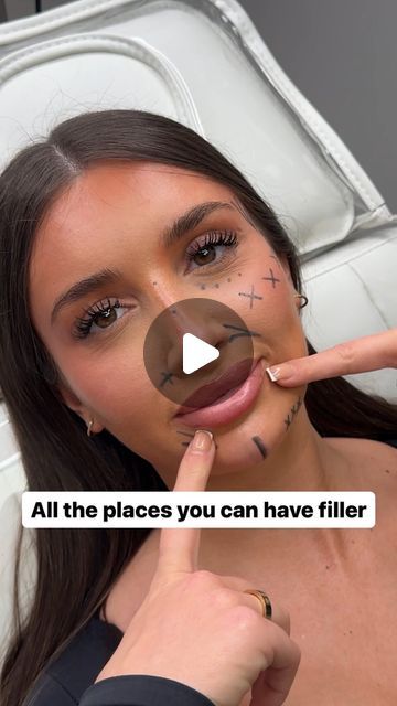 Where To Inject Lip Filler, Face Fillers Before And After Cheeks, Full Face Fillers Before And After, Filler Before And After Face, Mid Face Filler, Cheek Filler Before And After, Temple Filler Before And After, Facial Fillers Before And After, Smile Line Fillers Before And After