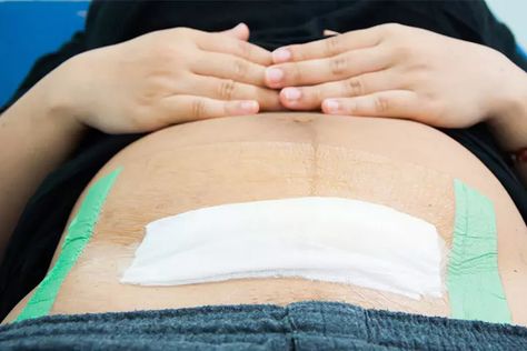 6 Warning Signs To Look For After C-Section Surgery Operasi Caesar, Delayed Cord Clamping, Woman Hacks, C Section Scars, Birth Partner, Emergency C Section, Cardiac Disease, Abdominal Surgery, Feeding Pillow