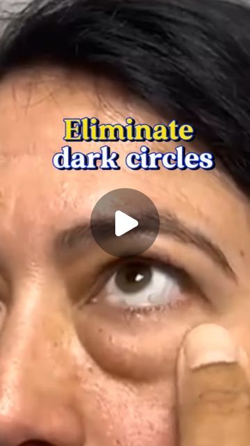 Home Remedies on Instagram: "Easiest remedy for reducing under eye dark circles, inder eye puffiness naturally & permanently. Prepare this magic for your eyes Eliminate Dark Circles and Under Eye Bags with this Natural Recipe...  #eyes #darkcirlcetreatment #remedy #foryou #naturalremedy #HealthyTips #naturalremedy #naturalremedies #remedy #recipe #usa #darkcircles #natural" Eliminate Dark Circles Under Eyes, Dark Eye Circles How To Get Rid Of, How To Cover Up Dark Circles Under Eyes, Under Eye Puffiness Remedies, Black Circles Under Eyes, Eye Puffiness Remedies, Preparation H For Eyes, Watery Eyes Remedy, Dark Rings Under Eyes