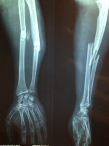 The Remarkable Process Behind Broken Bone Healing Limb Lengthening, Bone Healing, Circus Design, Bone Fracture, Orthopedic Surgery, Hampton Roads, Sports Medicine, Good Doctor, Dark Aesthetic