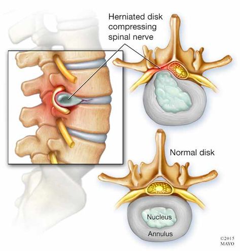 Mayo Clinic Q and A: Herniated disk symptoms often effectively treated without surgery – Mayo Clinic News Network Disk Herniation, Bulging Disc, Spinal Nerve, Chiropractic Adjustment, Back Pain Remedies, Spine Health, Spine Surgery, Upper Back Pain, Sciatica Pain