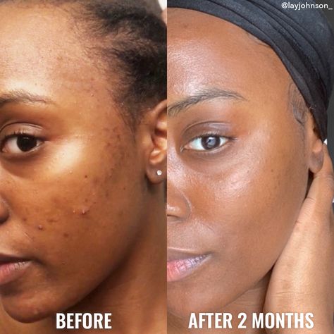 Discoloration Correcting Serum Discoloration On Face, Discoloration Correcting Serum, Good Molecules, Exfoliating Toner, Skin Care Quiz, Dewy Makeup, Retinol Cream, Tranexamic Acid, Effective Skin Care Products