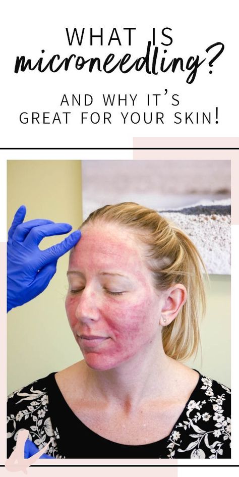 What is microneedling and what benefits will it bring to your skin. Sharing my experience, including before and after pictures of my face, as I try to smooth out my acne scars. I highly recommend seeing a professional for micro needling with prp! #microneedling #acnescars #cupcakesandcutlery #beauty Derma Roller Before And After, Prp Microneedling, Micro Needling, Acne Scar, Acne Scar Removal, Natural Cough Remedies, Scar Removal, Acne Remedies, After Pictures