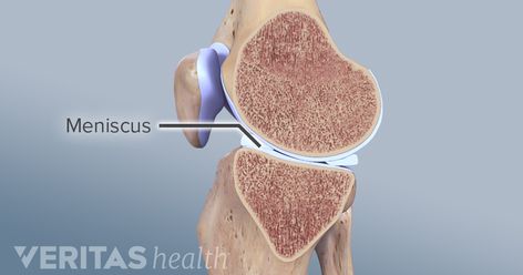 Meniscus Repair Surgery Recovery, Meniscus Surgery Recovery, Meniscus Surgery, Knee Surgery Recovery, Knee Strength, Knee Surgery, Surgery Recovery, Sports Injury, Knee Injury