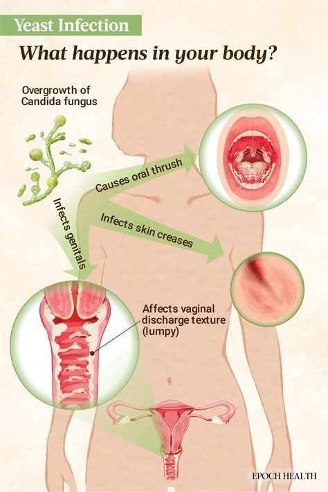 Yeast Infection: Symptoms, Causes, Treatments, and Natural Approaches | The Epoch Times Yeast Infection Symptoms, Candida Albicans, Things Under A Microscope, Medicinal Herbs, Yeast, Cider, Well Being, Health