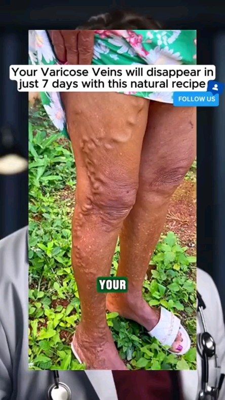 Naturalremedies.com , Herbalhealing , Modern Herbalist | Varicose veins are caused by weakened or damaged valves in the veins. Normally, veins have one-way valves that help keep blood flowing... | Instagram Vein Health, Varicose Vein Removal, Varicose Vein Remedy, Vein Removal, Birth Control Pills, Hormone Replacement, Detoxify Your Body, Diy Hair Care, Hormonal Changes