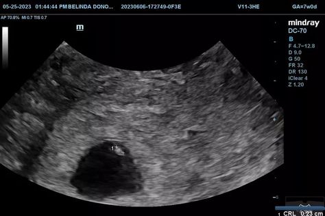 A still ultrasound image shows an unborn baby at 5 weeks 6 days. Telephone Interview, Baby Ultrasound, Nurse Manager, Knights Of Columbus, Menstrual Period, Unborn Baby, Corporate Communication, Planned Parenthood, Anime Baby