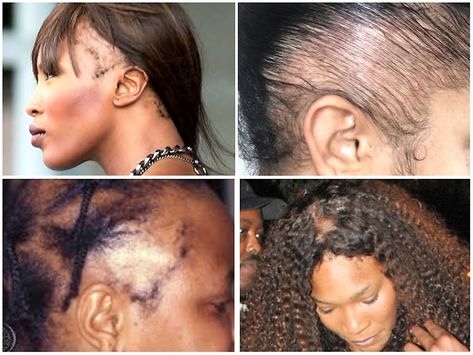 Traction Alopecia Regrowth, Regrow Eyebrows, Alopecia Hair Growth, Alopecia Hairstyles, Traction Alopecia, Edges Hair, How To Grow Natural Hair, Hair Issues, Hair Due