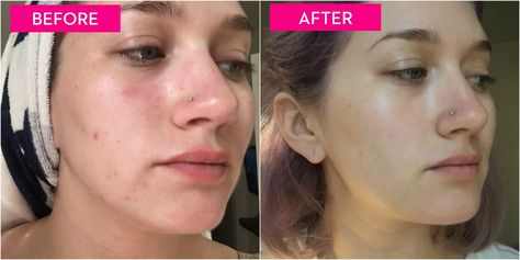 This editor wanted to break her bad habit and better her skin, so she embarked on a weeklong experiment to stop popping and picking once and for all. Click through to see her amazing skin transformation. Skin Picking, Pimples Under The Skin, Pimples Remedies, I Gave Up, Face Makeup Tips, Young Skin, Skin Complexion, Gave Up, How To Get Rid Of Acne