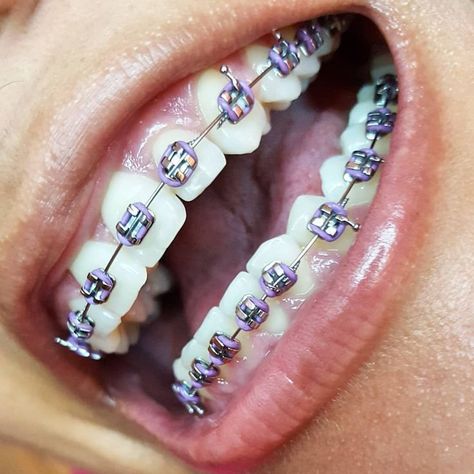 Braces Colours, Dental Braces Colors, Invisible Teeth Braces, Braces Ideas, Braces Cute, Braces Colors Ideas, Braces Smile, Natural Teeth Whitening Diy, Braces Bands