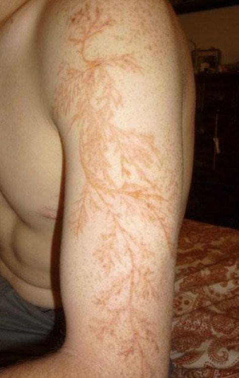 Scar from lightning "Lichtenberg figure" Lightning Scar, Lichtenberg Figures, Lightning Tattoo, Struck By Lightning, Fractal Patterns, E Mc2, Lightning Strikes, Blender 3d, Science And Nature