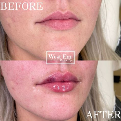 Lip filler, before and after, plump and hydrated lips, restylane filler Lip Filler, Eleanor Roosevelt, Medical Spa, Lip Fillers, Be Beautiful, A Couple, A Woman, Spa, Lips