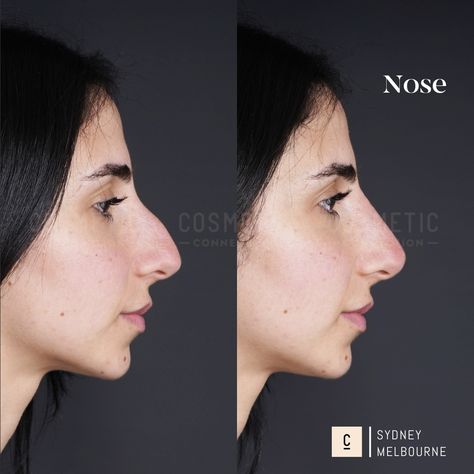 Our non-surgical rhinoplasty is a 15-minute injectable procedure that immediately improves the appearance of your nose. It’s a highly effective solution that can: - Hide bumps and humps - Lift and refine your nose tip - Slim and define your nose bridge - Balance the shape and size of your nose - Straighten a crooked nose - Improve poor surgical rhinoplasty results ⁠ Did you love this result? Want to know if it's right for you? Comment 'NOSE' to claim your complimentary opinion. ⁠⁠⁠ This con... Neck Lift Surgery, Double Chin Reduction, Nose Fillers, Nose Tip, Crooked Nose, Nose Jobs, Chin Augmentation, Nose Reshaping, Anti Wrinkle Injections