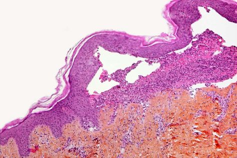 People with recessive dystrophic epidermolysis bullosa, a genetic condition that causes widespread skin blistering, have been successfully treated by inserting new collagen genes into their skin Epidermolysis Bullosa, Genetic Engineering, Gene Therapy, Genetic Disorders, Collagen Protein, Skin Condition, Skin Disorders, Cold Sore, Spinal Cord