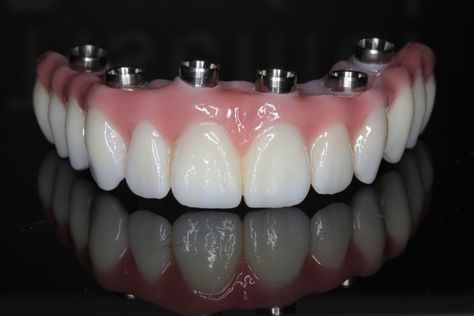 Free Dental Implants, Affordable Dental Implants, Dental Implant Procedure, Denture Implants, Dental Restoration, Dental Implants Cost, Laser Teeth Whitening, Tooth Replacement, Teeth Implants