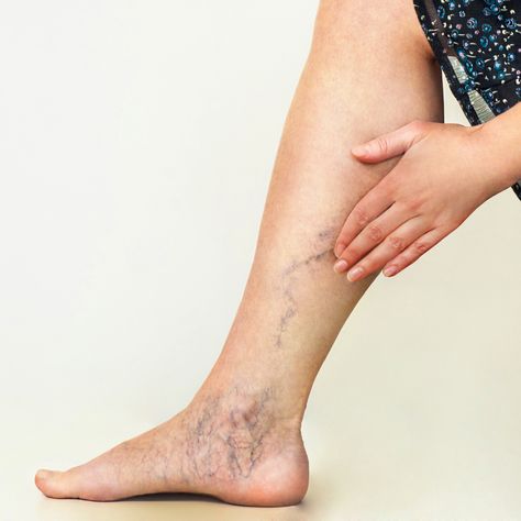 Varicose Veins Causes, Home Remedies For Spiders, Leg Veins, Vein Removal, Venous Insufficiency, Muscle Aches, Blood Flow, Cider, Aloe Vera