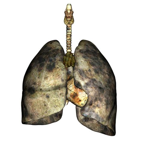 Lung Disease. 3D render of diseased lungs #Sponsored , #AFFILIATE, #SPONSORED, #Disease, #diseased, #render, #Lung Lungs Sculpture, Lungs Illustration, Path Illustration, Pollution Activities, Lungs Art, Anatomy Science, Ib Art, Mri Scan, Wallpapers Android