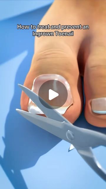 Dr Noman M | Ingrown toenail - prevention / management 
#drnomzzy #ingrowntoenail #toe | Instagram Ingrown Toenail Remedies, Toenail Removal, Ingrown Toenail, Ingrown Toe Nail, Dehydrated Skin, Combination Skin, Skin Tightening, Toe Nails, Skincare Routine