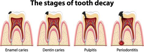 Poster Idea, Dental Laboratory, Tooth Decay, Vector Free, For Free, Human, Quick Saves