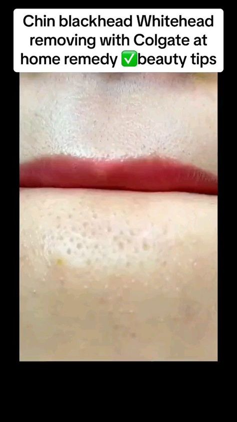 how to get rid of blackheads and Whiteheads ✨💋 Blackheads And Whiteheads, For Blackheads, Rid Of Blackheads, Face Skin Care Routine, Blackheads Removal, Clear Healthy Skin, Diy Skin Care Routine, Natural Face Skin Care, Good Skin Tips