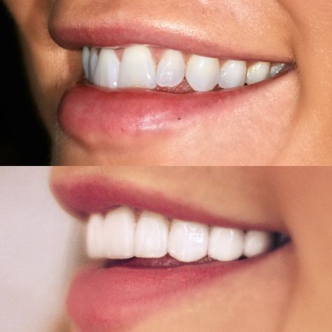 Veneers Before & After: The Prep, The Decision, The Results | Cella Jane Perfect Veneers Teeth, Veneers Before And After Small Teeth, Hollywood Smile Veneers, Dental Veneers Before And After, Teeth Veneers Before And After, Porcelain Veneers Before And After, Composite Veneers Before And After, Veneers Teeth Styles, Veneers Before And After