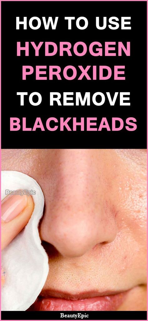 how to use hydrogen peroxide to remove blackheads Natural Remedy For Cough, Natural Remedies For Sore Throat, Gallbladder Health, Natural Remedies For Cough, Cold Sore Remedies, Home Remedies For Cough, For Sore Throat, To Remove Blackheads, Cold Relief