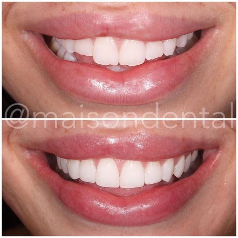 Maison Dental on Instagram: “One from the London clinic 💥 ⠀⠀⠀⠀⠀⠀⠀⠀⠀ This case was a combination of composite edge bonding on the front 6 teeth and composite veneers on…” Edge Bonding Teeth Before And After, Composite Edge Bonding Teeth, Edge Bonding Teeth, Composite Veneers Before And After, Teeth Bonding Before And After, Composite Bonding Teeth, Teeth Composite, Big Front Teeth, Perfect Teeth Smile