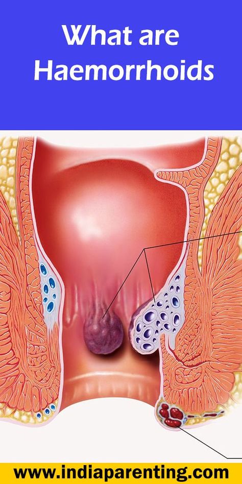 What are Haemorrhoids Hemorrhoid Removal, Thrombosed Hemorrhoid, Hemorrhoid Remedies, Hemorrhoid Relief, Sleep Remedies, Surgery Recovery, Health Planner, Easy Yoga Workouts, Back Pain Relief