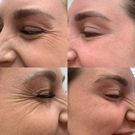 Em Sculpting Before And After, Face Injections, Jaw Reduction Surgery, Pdo Thread Lift, Botox Results, V Line Surgery, Botox Facial, Plastic Surgery Fail, Face Surgery