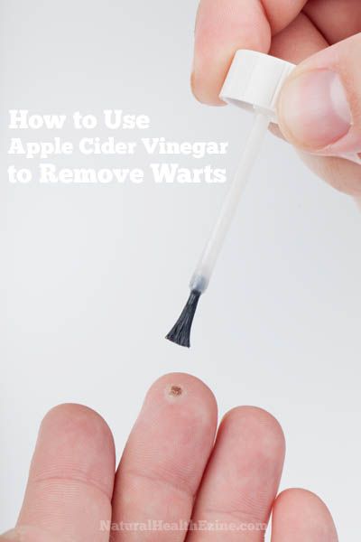 Did you know that you can bust a wart off in no time with Apple Cider Vinegar (or as it is affectionately known as ACV)? Organic Oregano Oil, Plantar Warts, Warts Removal, Warts On Hands, Warts On Face, Home Remedies For Warts, How To Remove Warts, Remove Skin Tags, Remove Warts