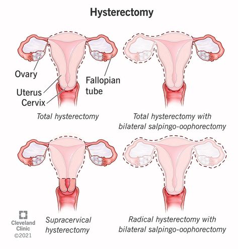 Hysterectomies Recovery, Enlarged Uterus, Prolapsed Uterus, Urinary Bladder, Uterine Prolapse, Nurse Teaching, Nurse Study Notes, Types Of Surgery, Surgery Recovery