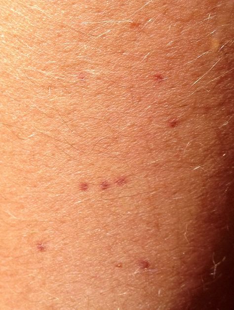 Orion constellation tattoo made to look like freckles! (Needs a touch up but you get the idea) Orion Constellation Tattoo, Freckle Tattoo, Orion Tattoo, Tattooed Freckles, Rat Tattoo, Tattoo Red, Stars Tattoo, Minimal Tattoos, Libra Constellation