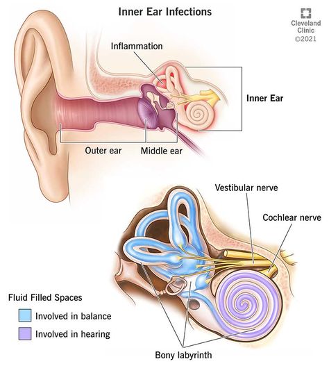 Inner Ear Infection: Symptoms, Signs & Causes Inner Ear Anatomy, Ear Drainage, Eustachian Tube Dysfunction, Neurological Assessment, Ear Tubes, Ear Anatomy, Vestibular System, Outer Ear, Basic Anatomy And Physiology