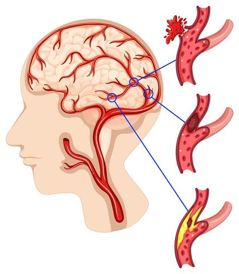 Brain Vector, Types Of Strokes, Vein Thrombosis, Abnormal Cells, Improve Brain Function, Light Blue Background, Human Brain, Brain Function, Warning Signs