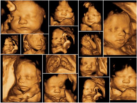 A new article claims that the heartbeats of unborn babies are "imaginary" and that unborn babies aren't really alive. 4d Ultrasound Pictures, Angel Prints, 3d Ultrasound, Hippocratic Oath, Care During Pregnancy, 4d Ultrasound, What Is Health, Ultrasound Pictures, Baby Scan