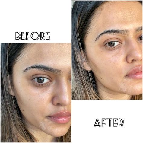 If you are a woman of color, especially if you are Indian, you know how under eye dark circles are kind of a problem for us Indian women. |dark circles| fade dark circles| Vitamin E | Almond oil| skincare routine| skincare regimen| Southasian skin| skincare| under eyes| antiaging| clean skincare| affordable skincare #skincareroutine #darkcircles #skincare #undereyes #antiaging Hyperpigmentation Around Eyes, Hyperpigmentation Indian Skin, Dark Circle Treatments, Indian Skincare Products, Hyperpigmentation Remedies, Color Correct Dark Circles, Skin Korean, Affordable Skincare, Hide Dark Circles