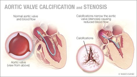 Aortic calcification: An early sign of heart valve problems? - Mayo Clinic News Network Aortic Valve Stenosis, Aortic Valve Replacement, Heart Valve, Calcium Deposits, Heart Valves, Heart Defect, Heart Problems, Shortness Of Breath, Mayo Clinic