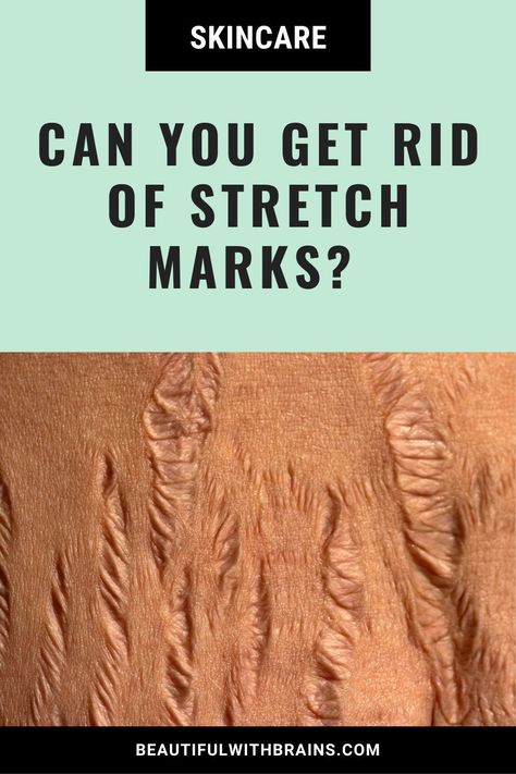 Unlock the Science. Say goodbye to stretch mark myths! Our article breaks down the science, offering practical methods for genuine improvement. Click through to discover realistic strategies without false promises. 🌟Try these Practical Tips Now! About: Stretch Marks, Skin Care False Promises, Strech Marks, Upper Lip Hair, Marks Cream, Stretch Mark Removal, Stretch Mark Cream, Stretch Mark, Lip Hair, How To Get Rid Of Acne