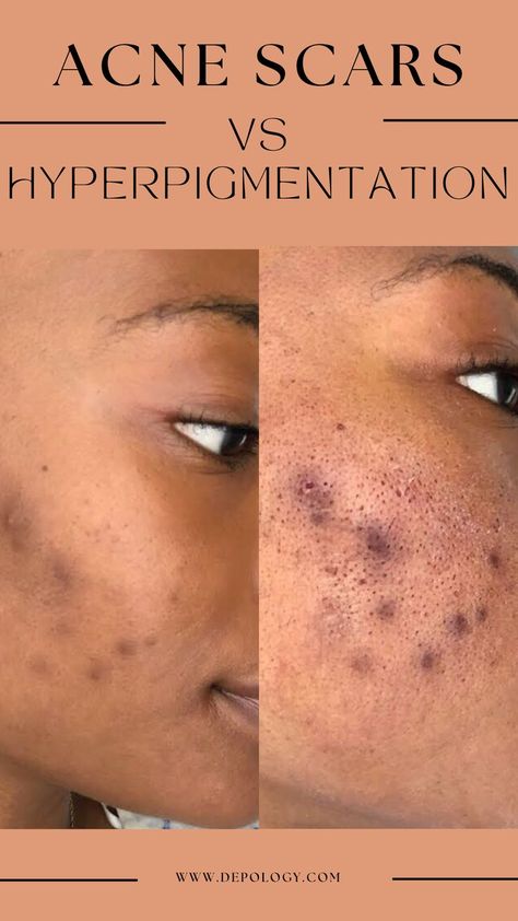 Acne and hyperpigmentation are two conditions that every person wants to avoid. The treatment also differs depending on one’s skin type. Skincare Terms, Pigmentation Remedy, Blind Pimple, Pimples Under The Skin, Melanin Skin, Acne Overnight, Pimples Overnight, Natural Acne Remedies, Under The Skin