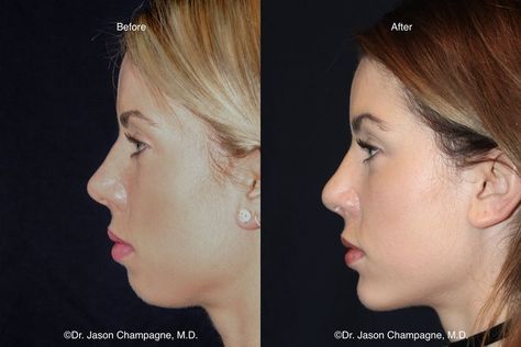 Chin Filler, Chin Augmentation, Chin Implant, Face Surgery, Facial Bones, Jaw Surgery, Facial Surgery, Facial Fillers, Facial Plastic Surgery